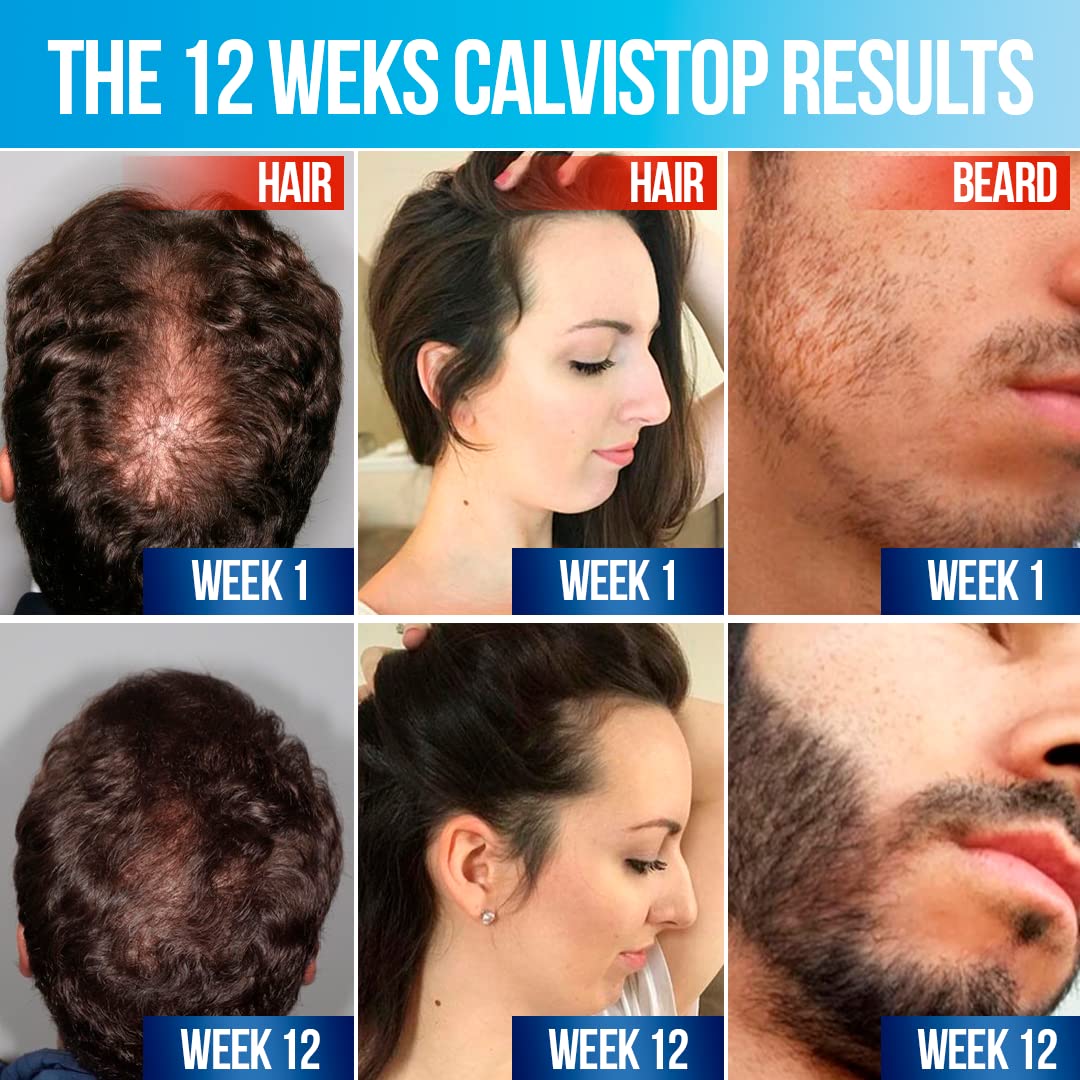 CalviStop Hair Loss Treatment - Stronger, Healthier India | Ubuy